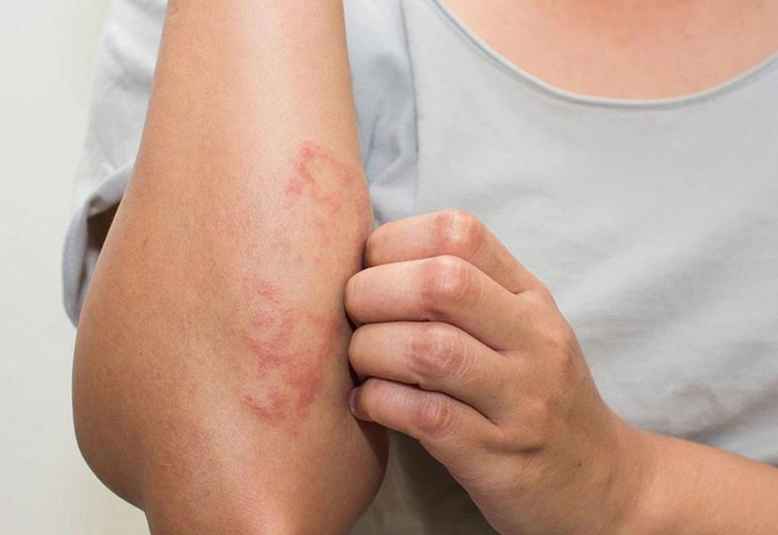 Xét nghiệm chẩn đoán lupus ban đỏ dựa trên công thức máu