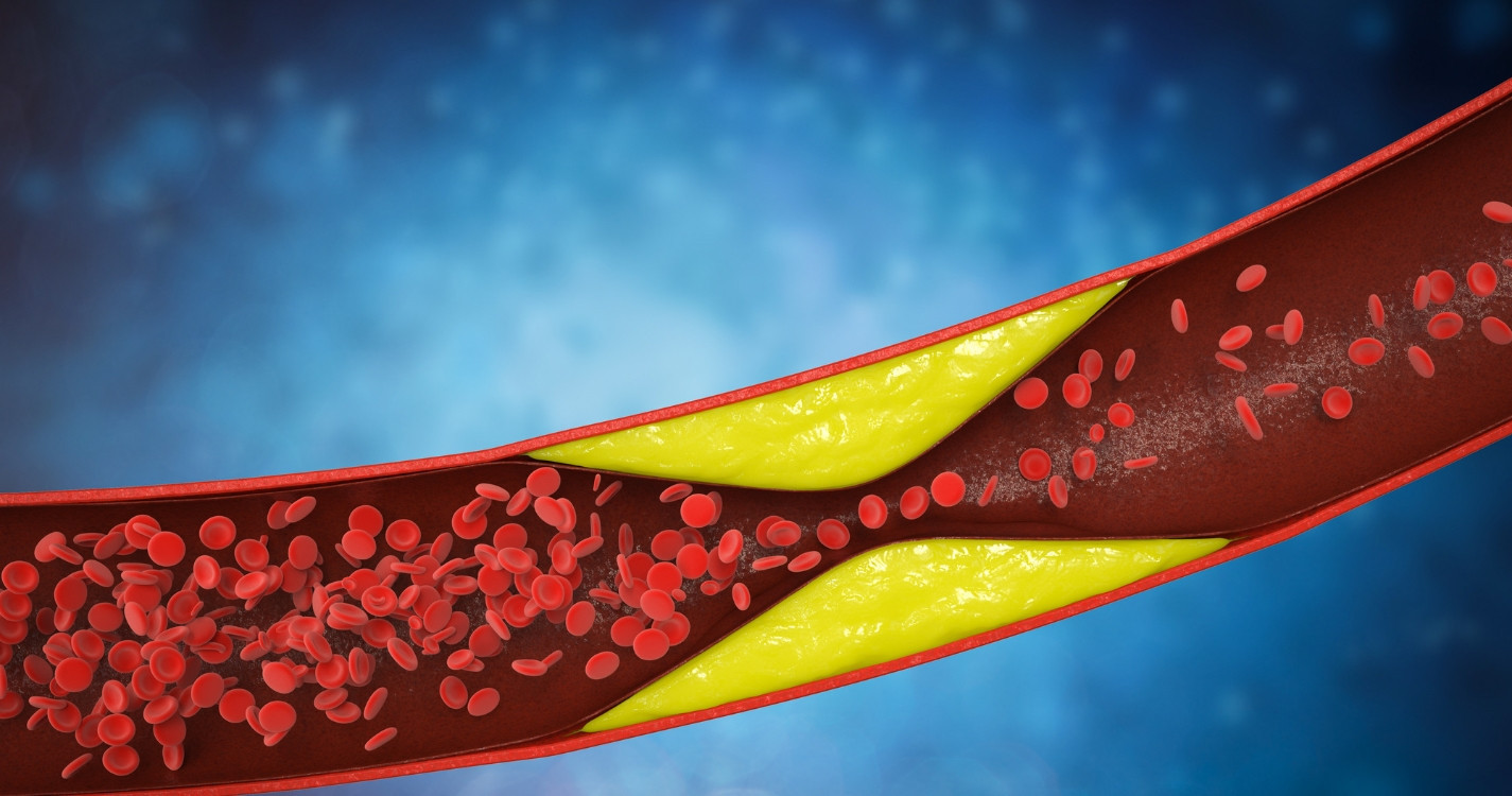 How to Lower Blood Lipids Without Medication?