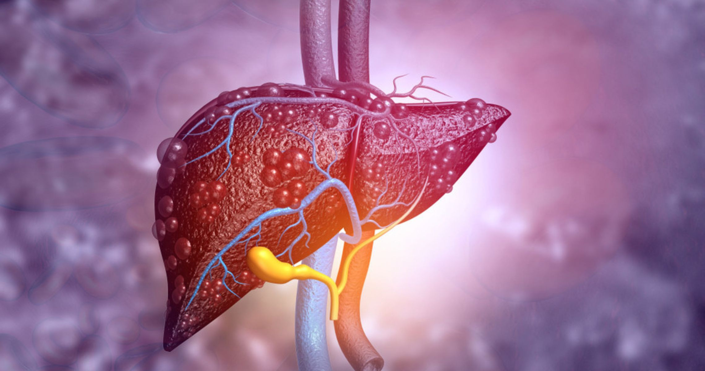 Treating Grade 1 Fatty Liver Disease for Middle-Aged Individuals