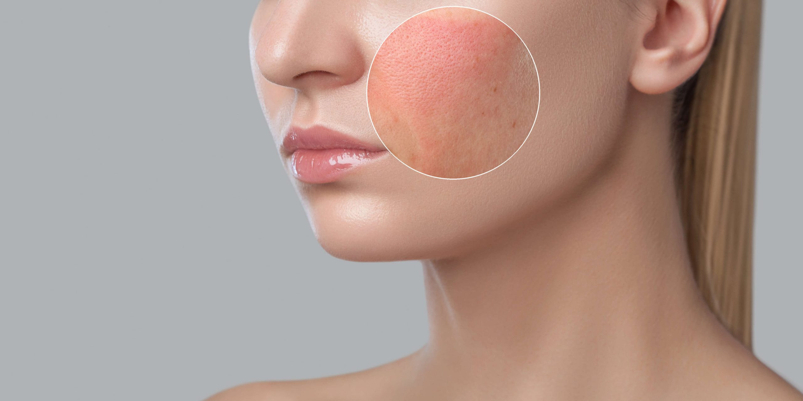 Can skin affected by corticosteroids undergo chemical peeling?