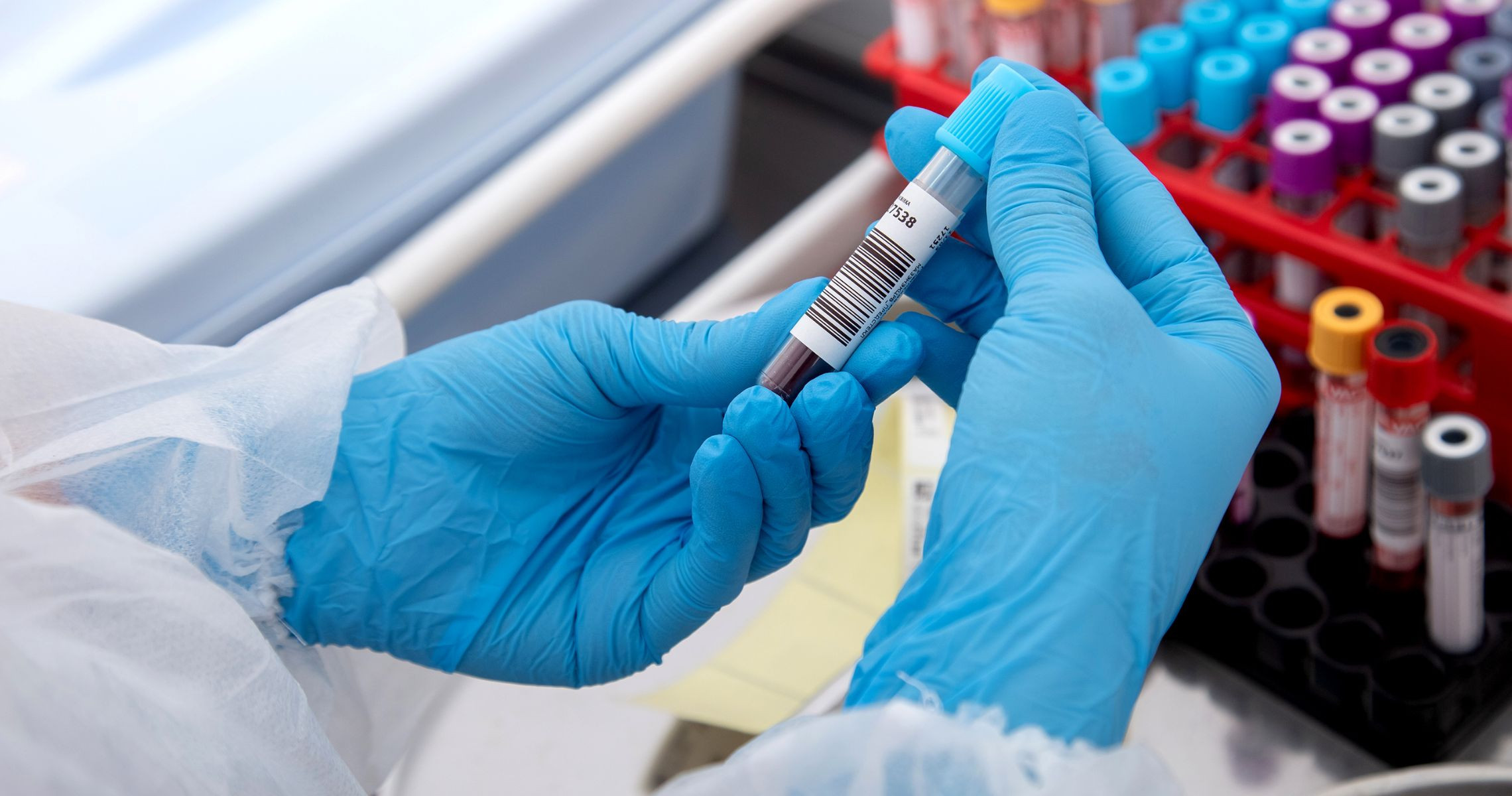 Is a creatinine level of 115 indicative of kidney disease or not?