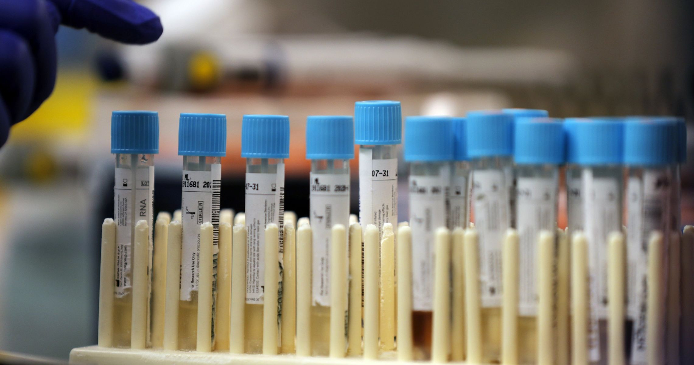 What does a red blood cell count of 50 ery/ul indicate? Is it acute nephritis?