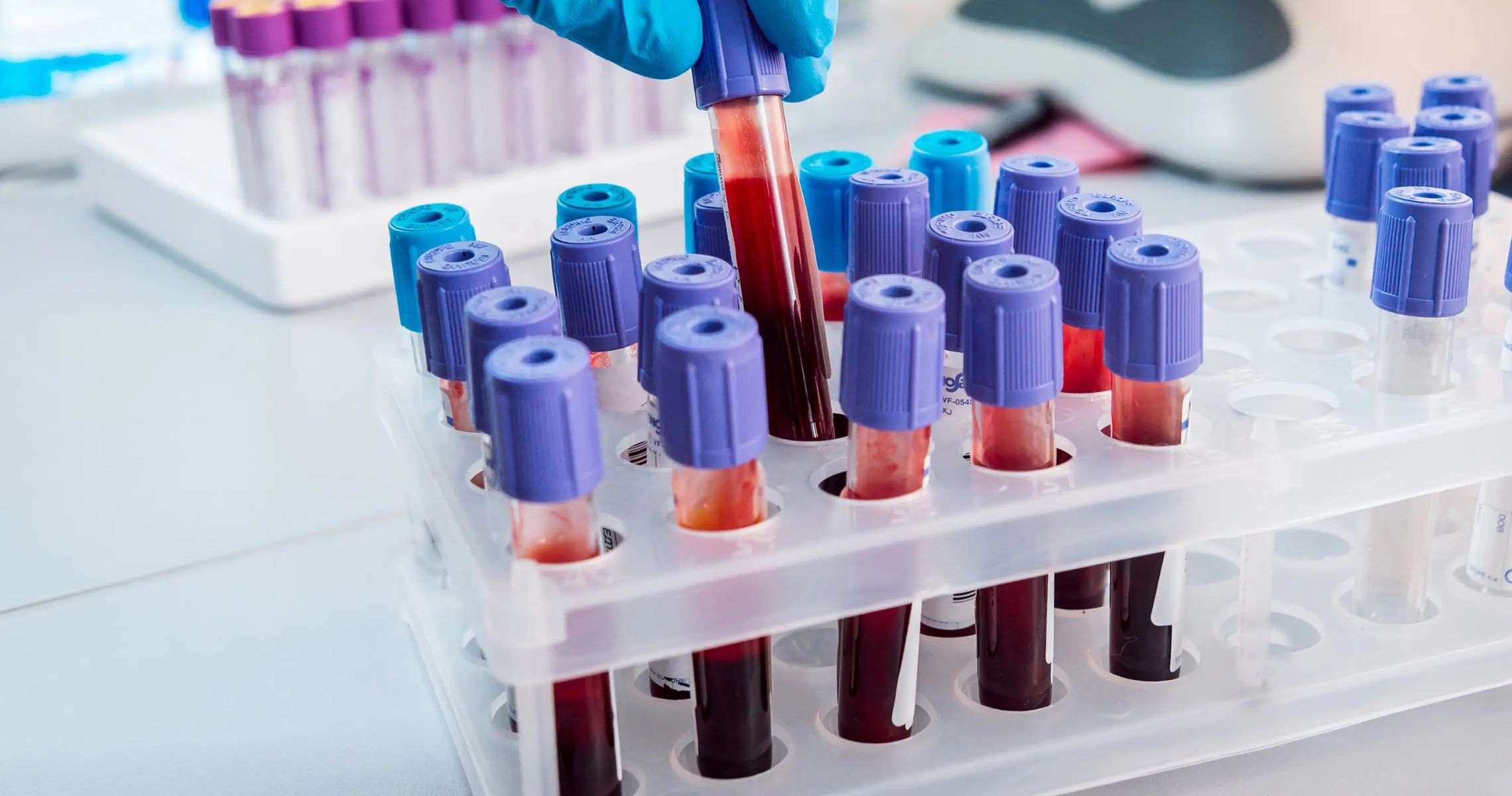 What does a uric acid level of 540 mean? What should I do with a uric acid level of 540?